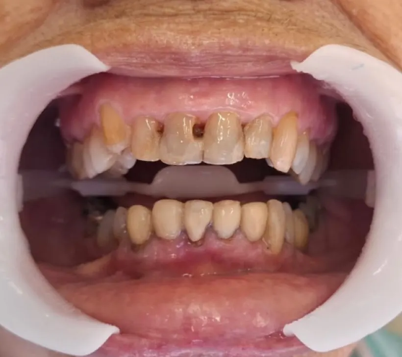 Sorriso antes das facetas dentárias