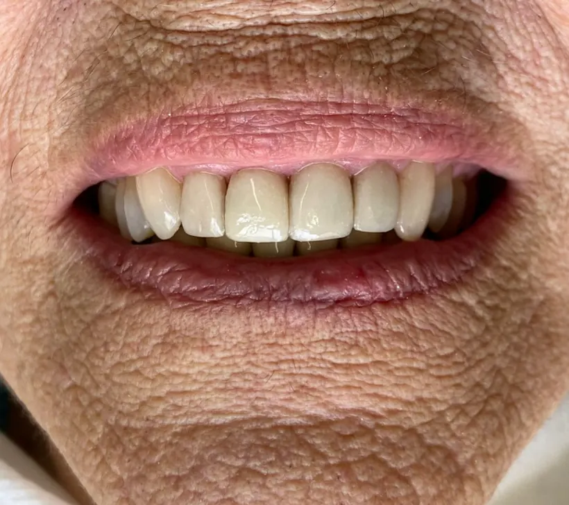 Sorriso depois das facetas dentárias