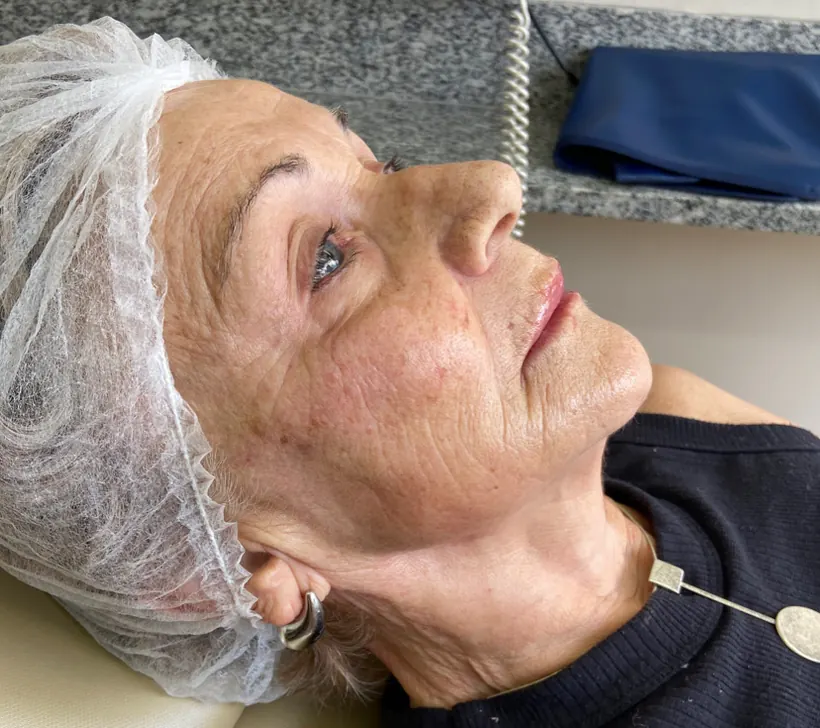 Terço inferior do rosto depois da harmonização orofacial