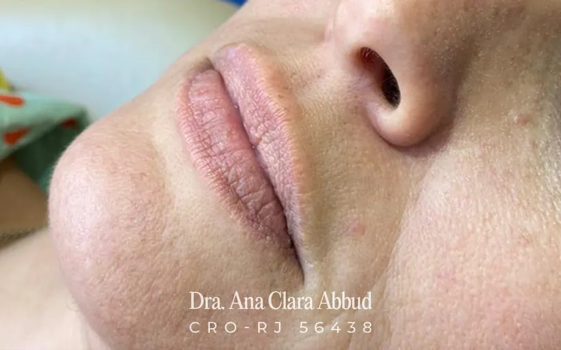 Lábios antes do preenchimento labial
