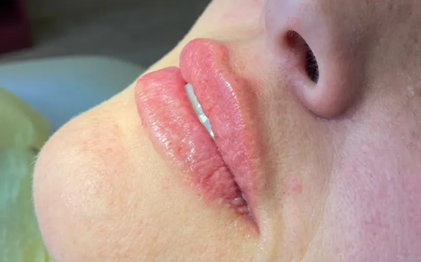 Lábios depois do preenchimento labial