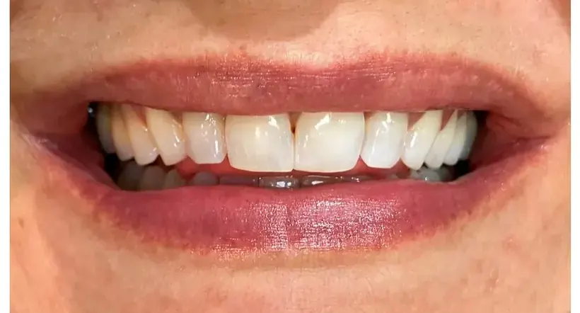 Sorriso depois do clareamento dental