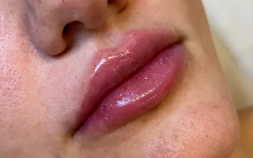 Lábios depois do preenchimento labial