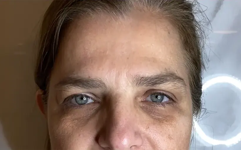 Região frontal depois da aplicação de toxina botulínica