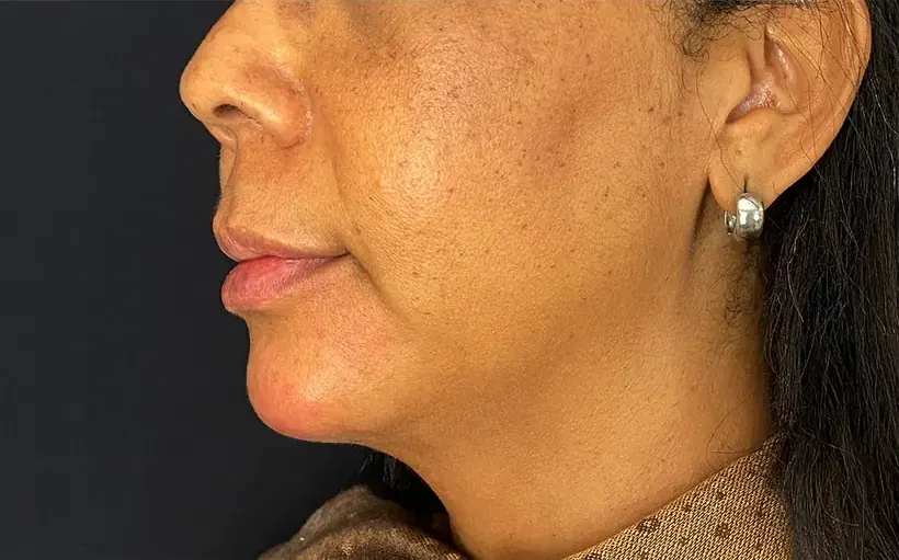 Terço inferior do rosto depois da harmonização orofacial